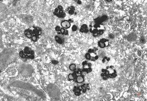 M,16y. | lipofuscin - hyperbilirubinaemia - Gilbert or Dubin-Johnson syndrome